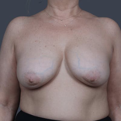 Implant Removal Before & After Gallery - Patient 116630 - Image 1