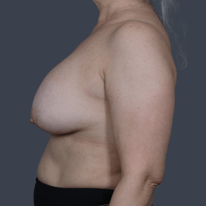 Implant Removal Before & After Gallery - Patient 116630 - Image 5