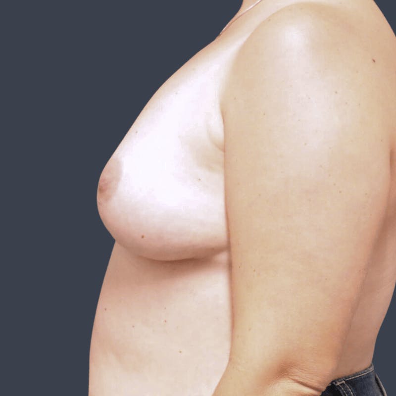 Implant Removal Before & After Gallery - Patient 385834 - Image 4