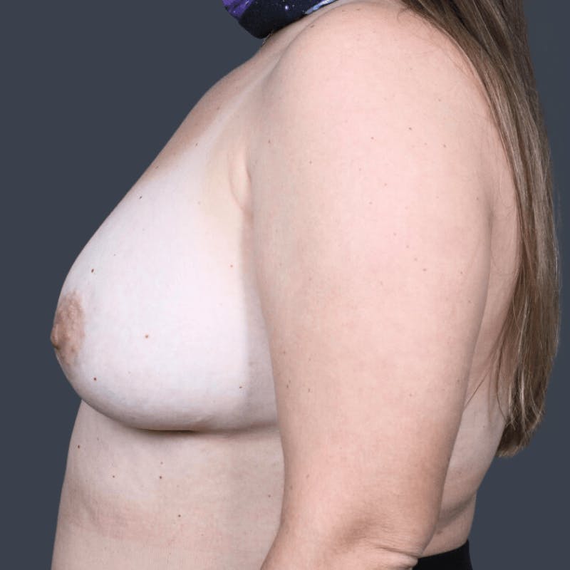 Implant Removal Before & After Gallery - Patient 385834 - Image 3