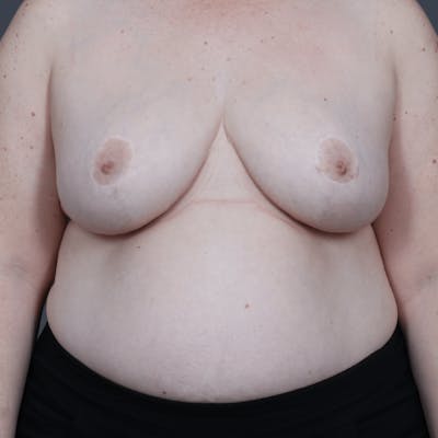 Breast Reduction Before & After Gallery - Patient 562071 - Image 2