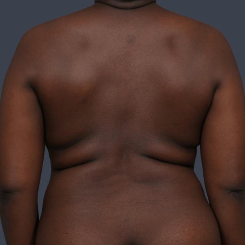 Abdominoplasty / Tummy Tuck Before & After Gallery - Patient 166771 - Image 5