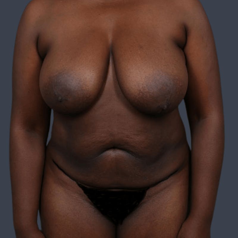 Abdominoplasty / Tummy Tuck Before & After Gallery - Patient 166771 - Image 1