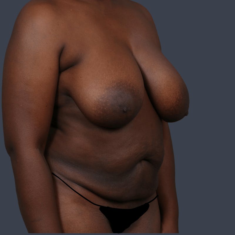 Abdominoplasty / Tummy Tuck Before & After Gallery - Patient 166771 - Image 3
