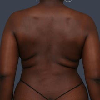 Abdominoplasty / Tummy Tuck Before & After Gallery - Patient 166771 - Image 6