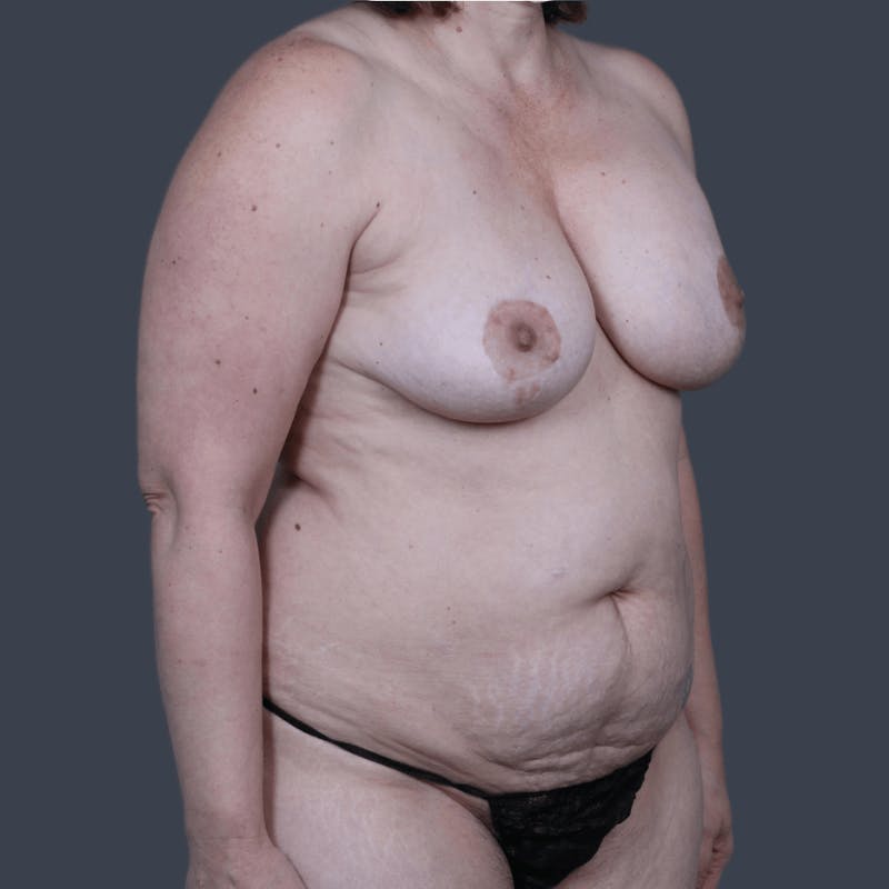 Implant Exchange Before & After Gallery - Patient 414139 - Image 3