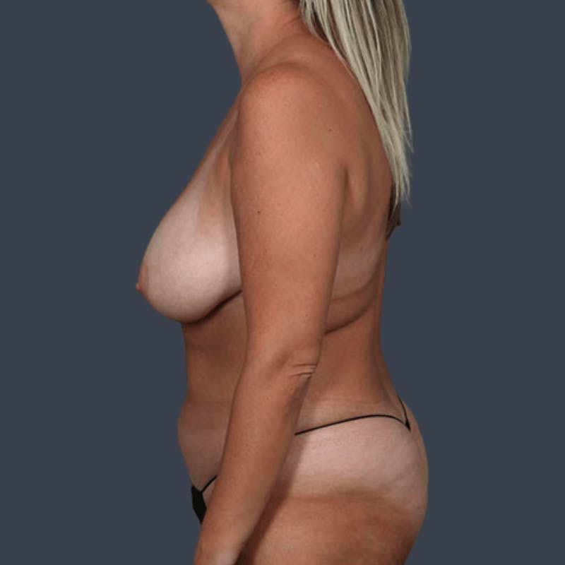 Breast Reduction Before & After Gallery - Patient 272804 - Image 5