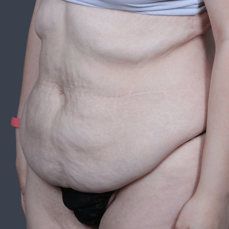 Abdominoplasty / Tummy Tuck Before & After Gallery - Patient 325386 - Image 3
