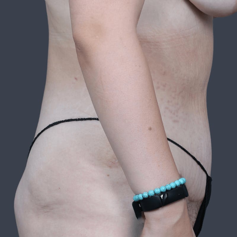 Abdominoplasty / Tummy Tuck Before & After Gallery - Patient 325386 - Image 6