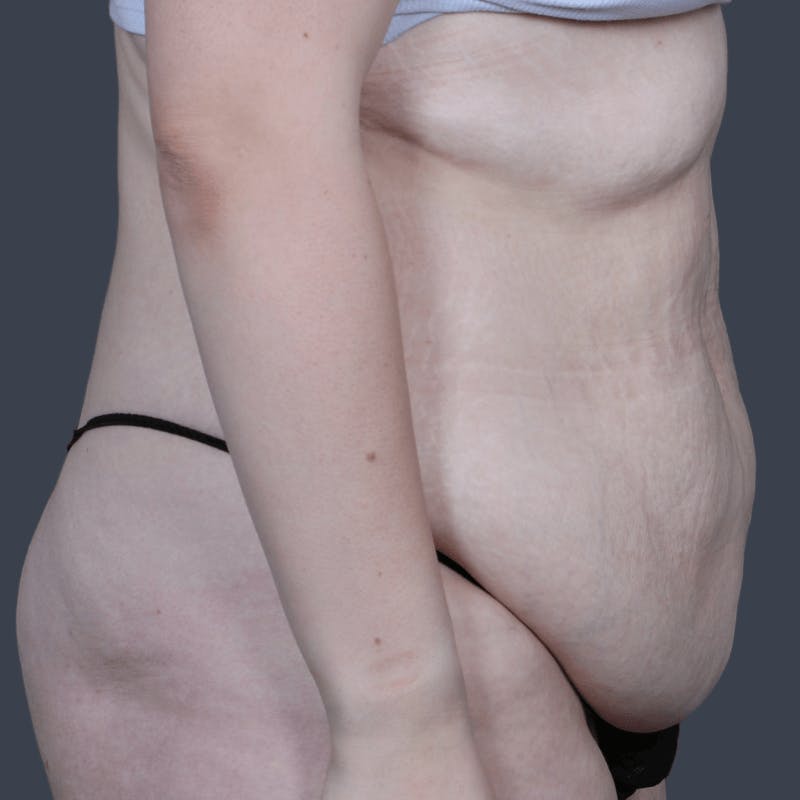 Abdominoplasty / Tummy Tuck Before & After Gallery - Patient 325386 - Image 5