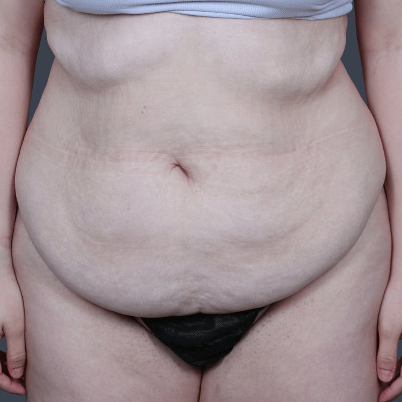 Abdominoplasty / Tummy Tuck Before & After Gallery - Patient 325386 - Image 1