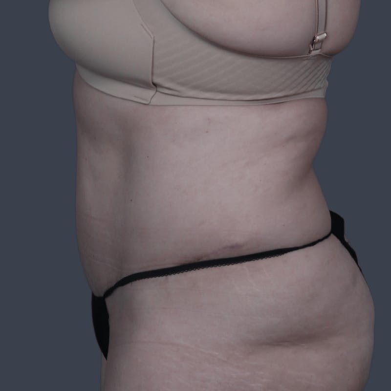 Abdominoplasty / Tummy Tuck Before & After Gallery - Patient 236712 - Image 4