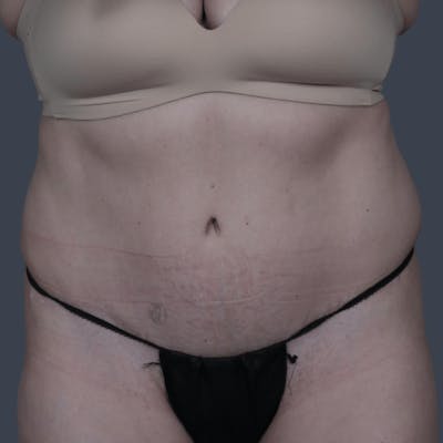 Abdominoplasty / Tummy Tuck Before & After Gallery - Patient 236712 - Image 2