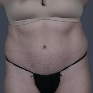 Abdominoplasty / Tummy Tuck Before & After Gallery - Patient 236851 - Image 2