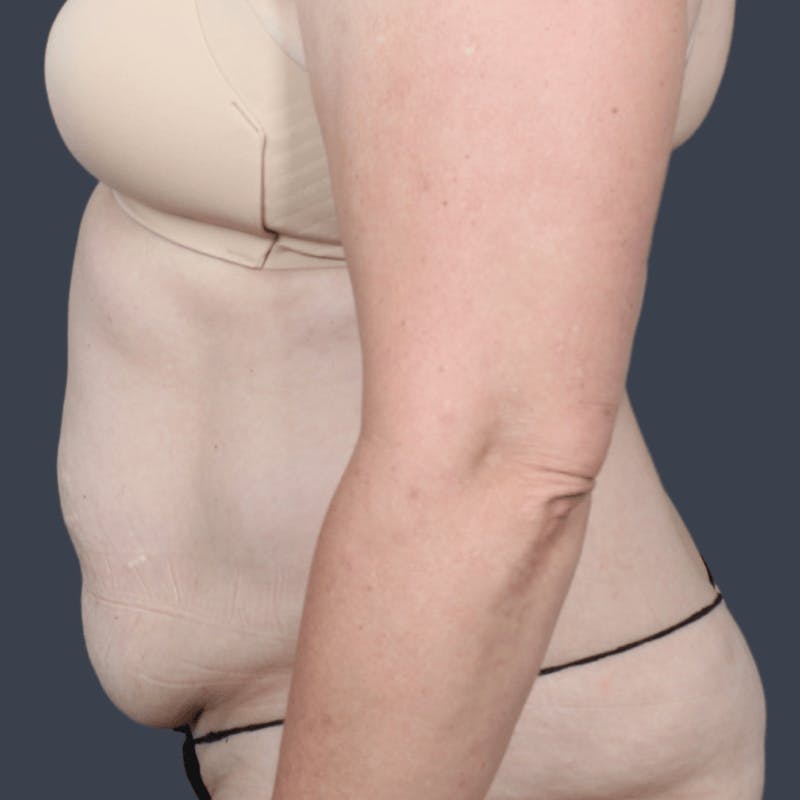 Abdominoplasty / Tummy Tuck Before & After Gallery - Patient 236712 - Image 5
