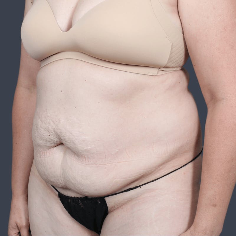 Abdominoplasty / Tummy Tuck Before & After Gallery - Patient 236712 - Image 3