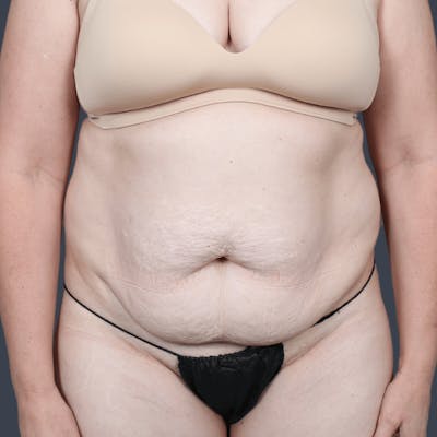 Abdominoplasty / Tummy Tuck Before & After Gallery - Patient 236712 - Image 1