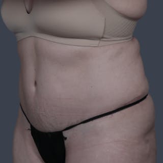 Abdominoplasty / Tummy Tuck Before & After Gallery - Patient 236851 - Image 6