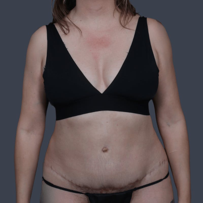 Abdominoplasty / Tummy Tuck Before & After Gallery - Patient 166977 - Image 2