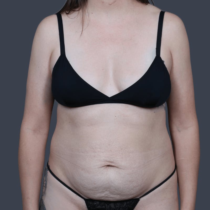 Abdominoplasty / Tummy Tuck Before & After Gallery - Patient 166977 - Image 1