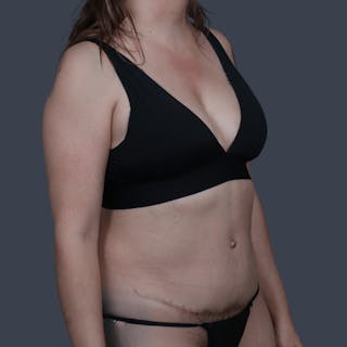 Abdominoplasty / Tummy Tuck Before & After Gallery - Patient 144577 - Image 6