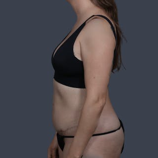 Abdominoplasty / Tummy Tuck Before & After Gallery - Patient 144577 - Image 4