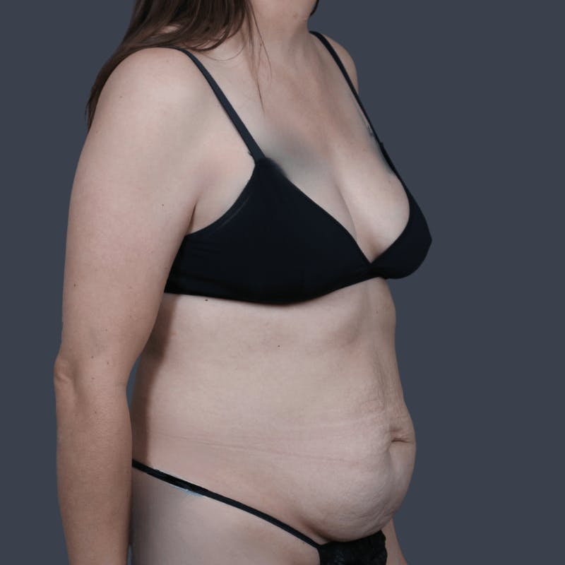 Abdominoplasty / Tummy Tuck Before & After Gallery - Patient 166977 - Image 5