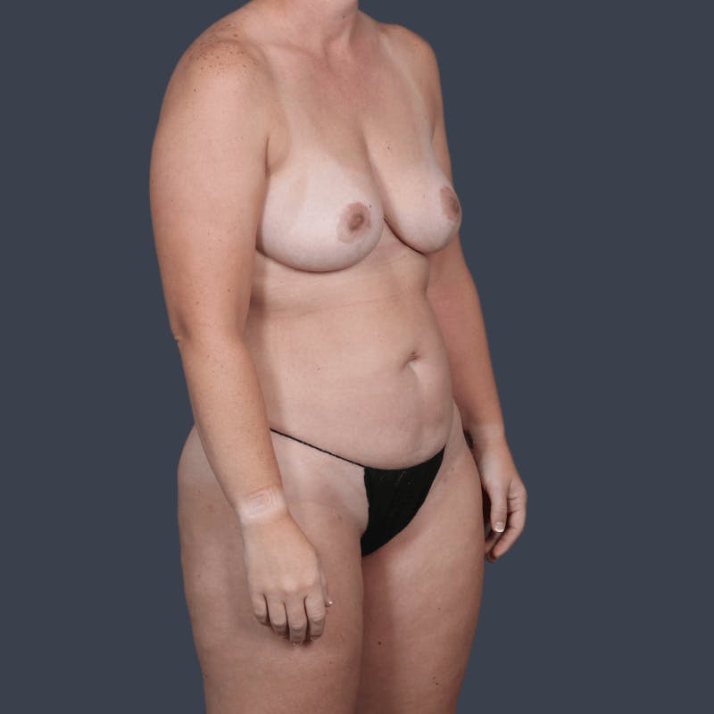 Liposuction Before & After Gallery - Patient 236814 - Image 6
