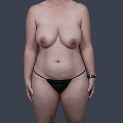 Breast Reduction Before & After Gallery - Patient 424441 - Image 1