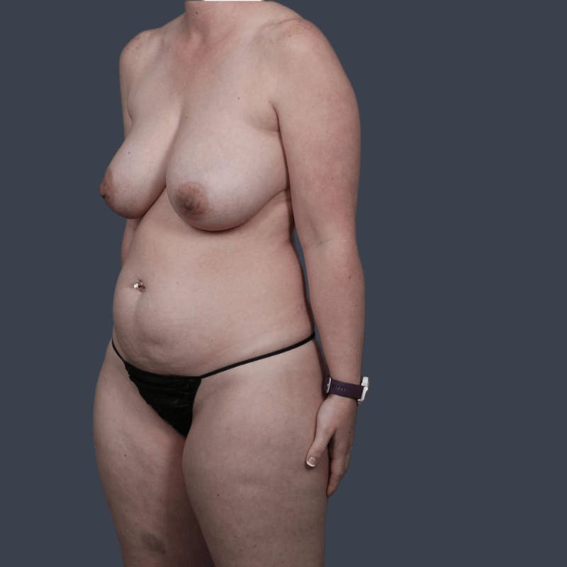 Liposuction Before & After Gallery - Patient 236814 - Image 3