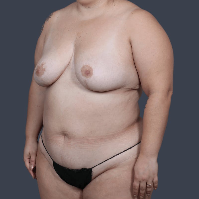 Liposuction Before & After Gallery - Patient 181576 - Image 6