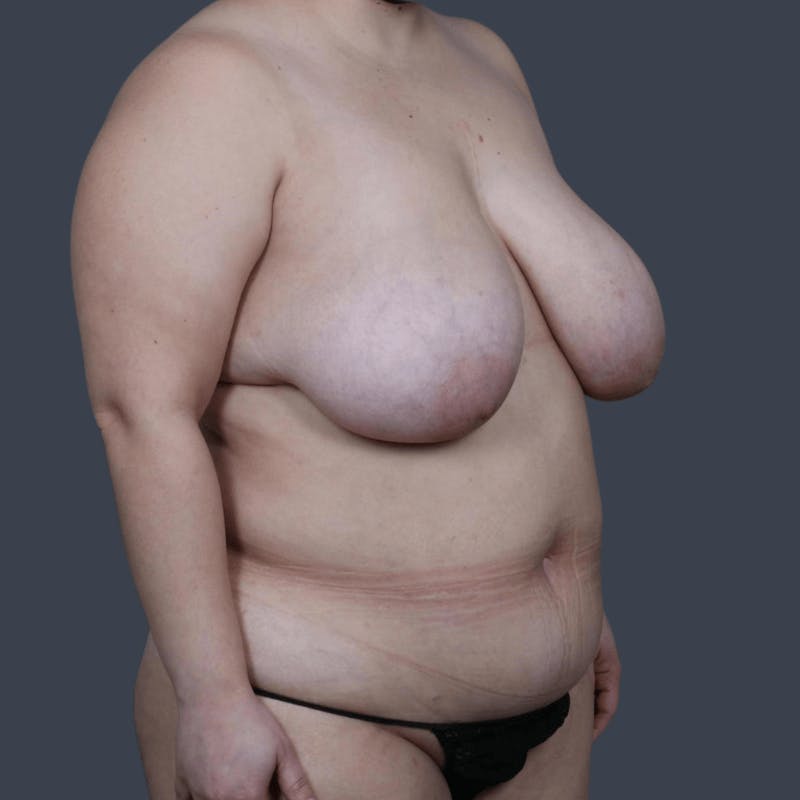 Liposuction Before & After Gallery - Patient 181576 - Image 4