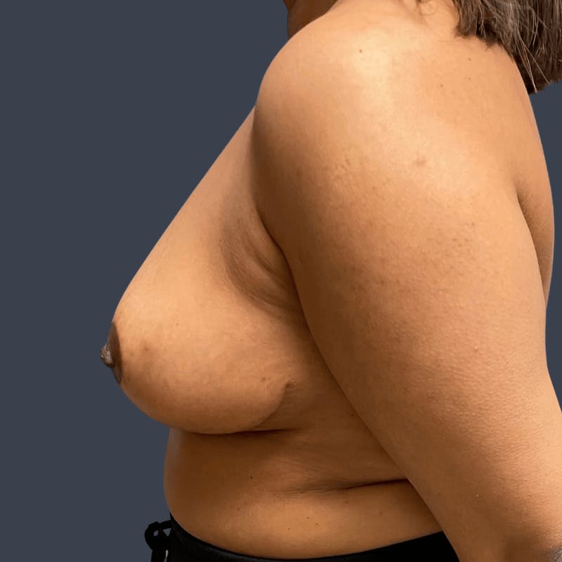 Breast Reduction Before & After Gallery - Patient 306906 - Image 6