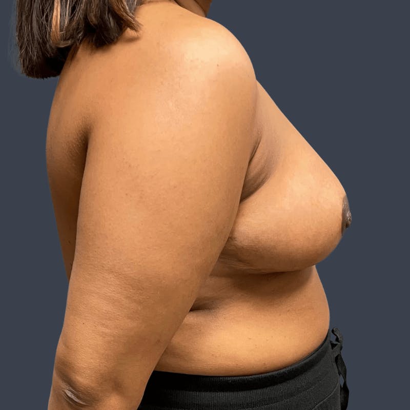 Breast Reduction Before & After Gallery - Patient 306906 - Image 4