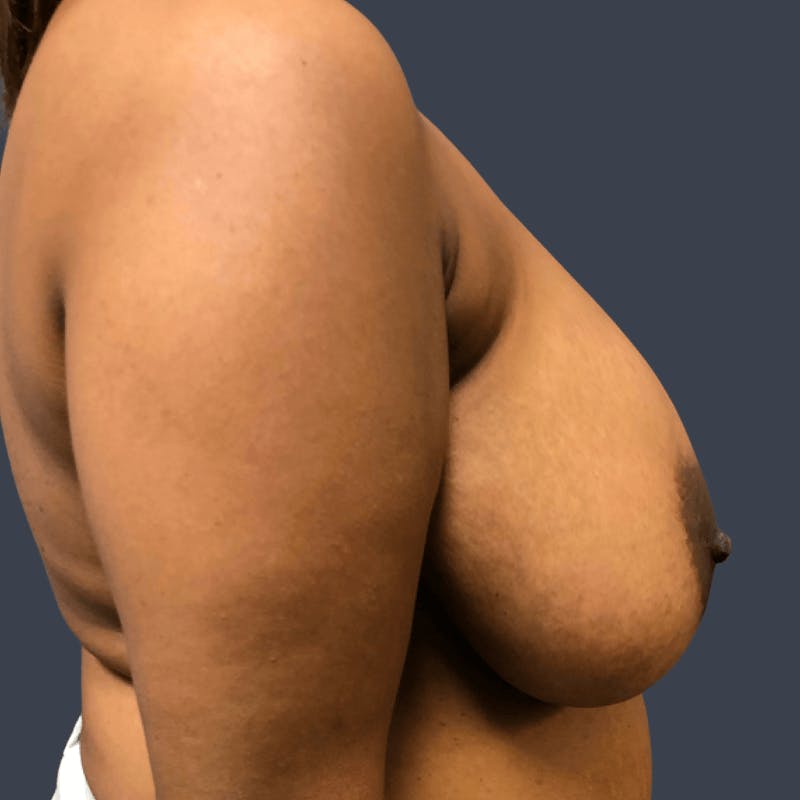 Breast Reduction Before & After Gallery - Patient 306906 - Image 3