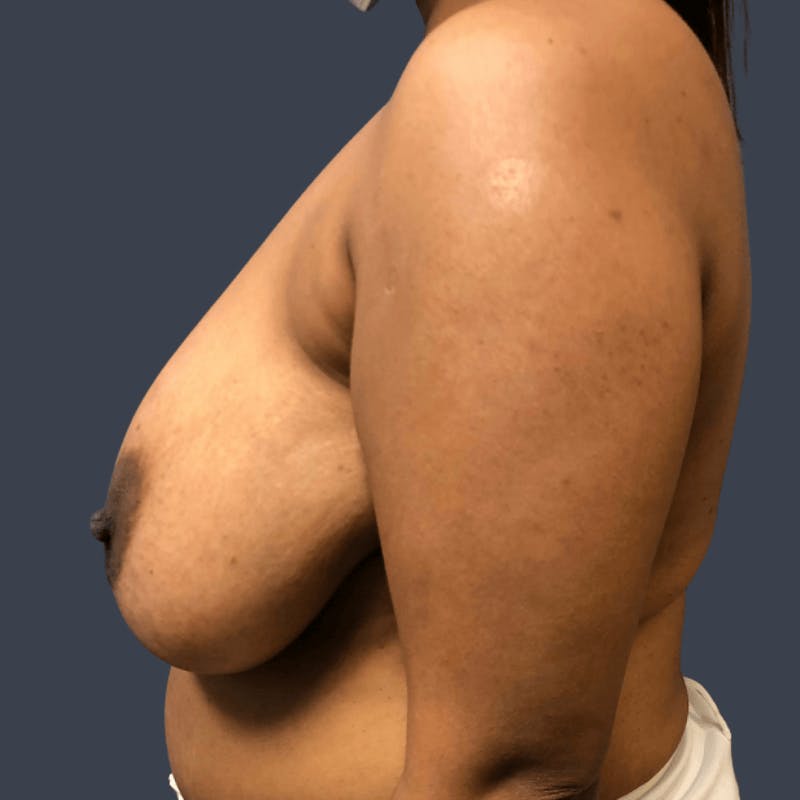 Breast Reduction Before & After Gallery - Patient 306906 - Image 5
