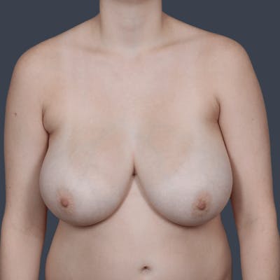 Breast Reduction Before & After Gallery - Patient 115200 - Image 1