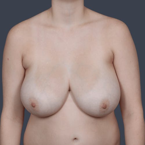 Before procedure image for Breast Reduction