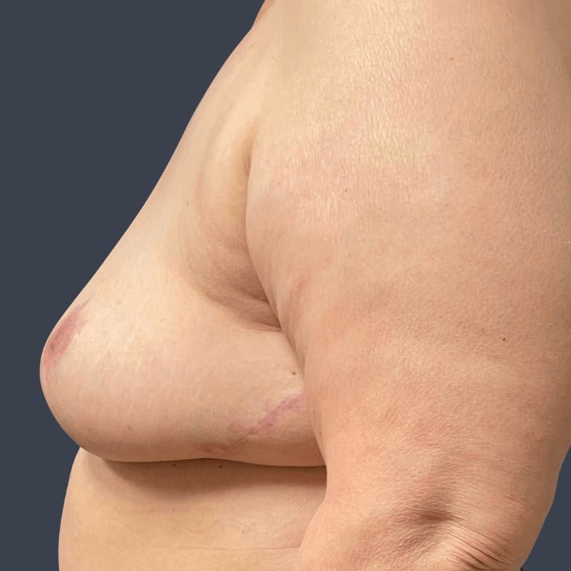 Breast Reduction Before & After Gallery - Patient 321929 - Image 6