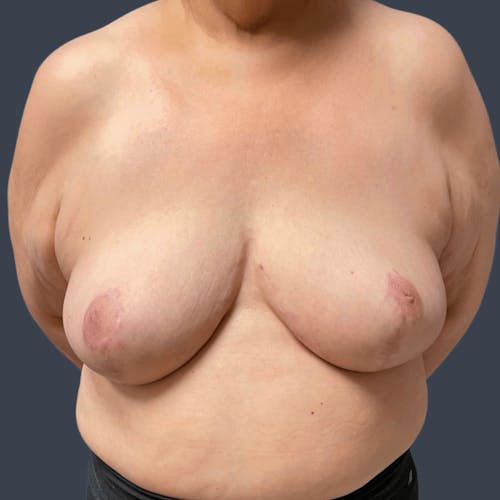 After procedure image for Breast Reduction