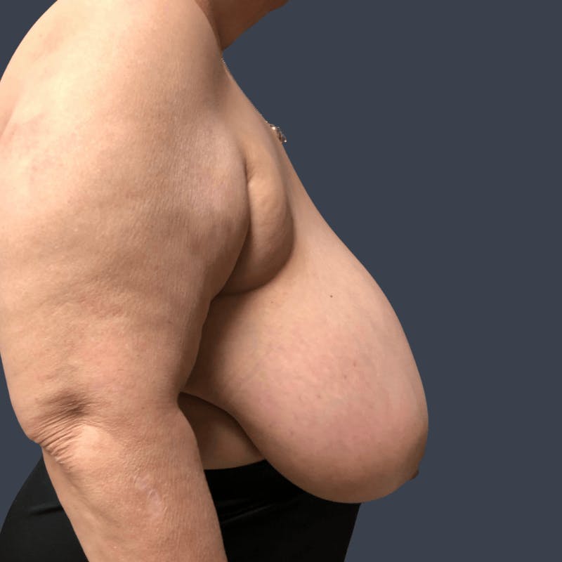 Breast Reduction Before & After Gallery - Patient 321929 - Image 3