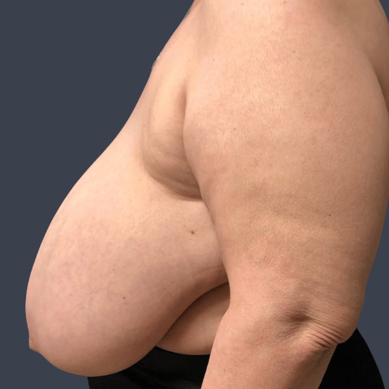 Breast Reduction Before & After Gallery - Patient 321929 - Image 5