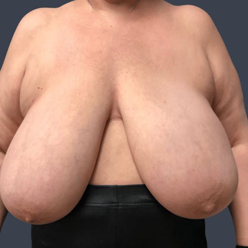 Before procedure image for Breast Reduction