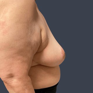 Breast Reduction Before & After Gallery - Patient 321929 - Image 4