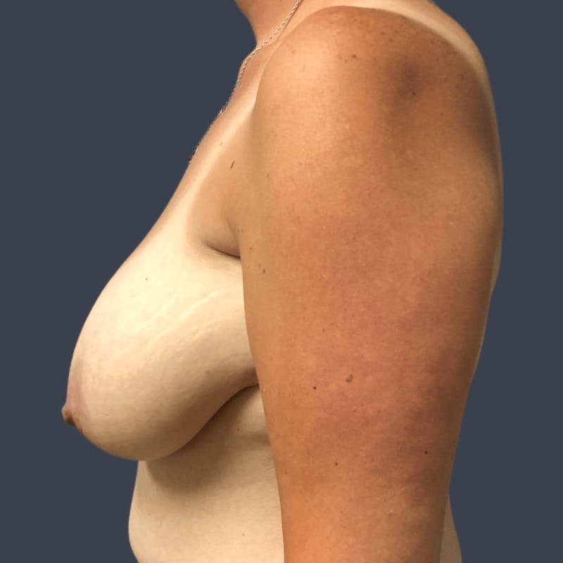 Breast Reduction Before & After Gallery - Patient 158332 - Image 3