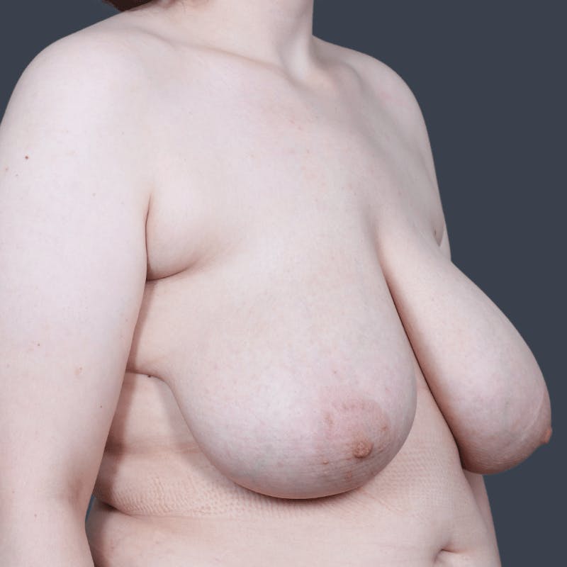 Breast Reduction Before & After Gallery - Patient 392122 - Image 3