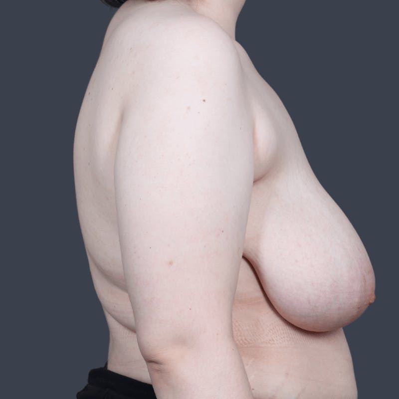 Breast Reduction Before & After Gallery - Patient 392122 - Image 5