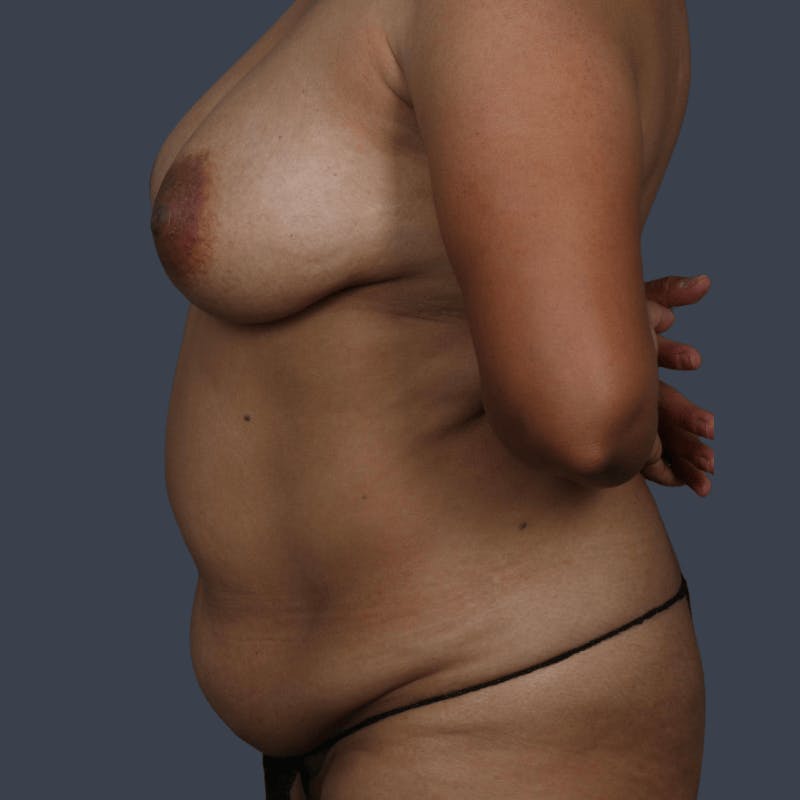 Breast Reduction Before & After Gallery - Patient 697182 - Image 5