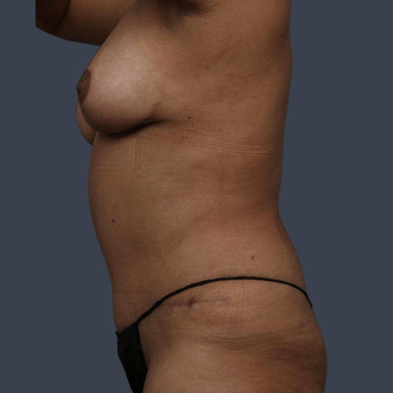 Breast Reduction Before & After Gallery - Patient 697182 - Image 6