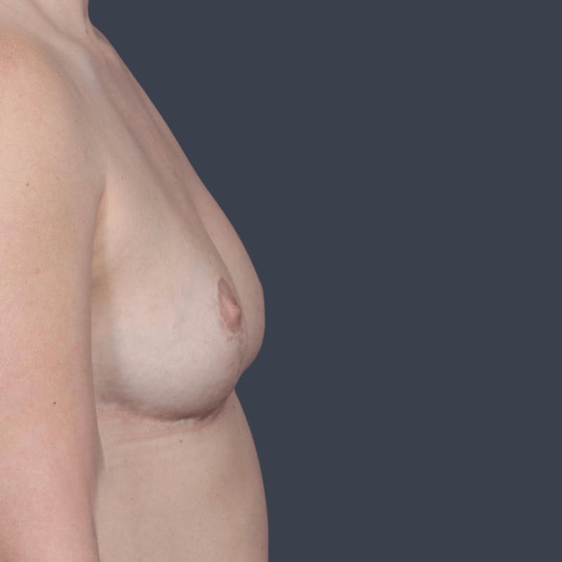 Breast Reduction Before & After Gallery - Patient 280417 - Image 6